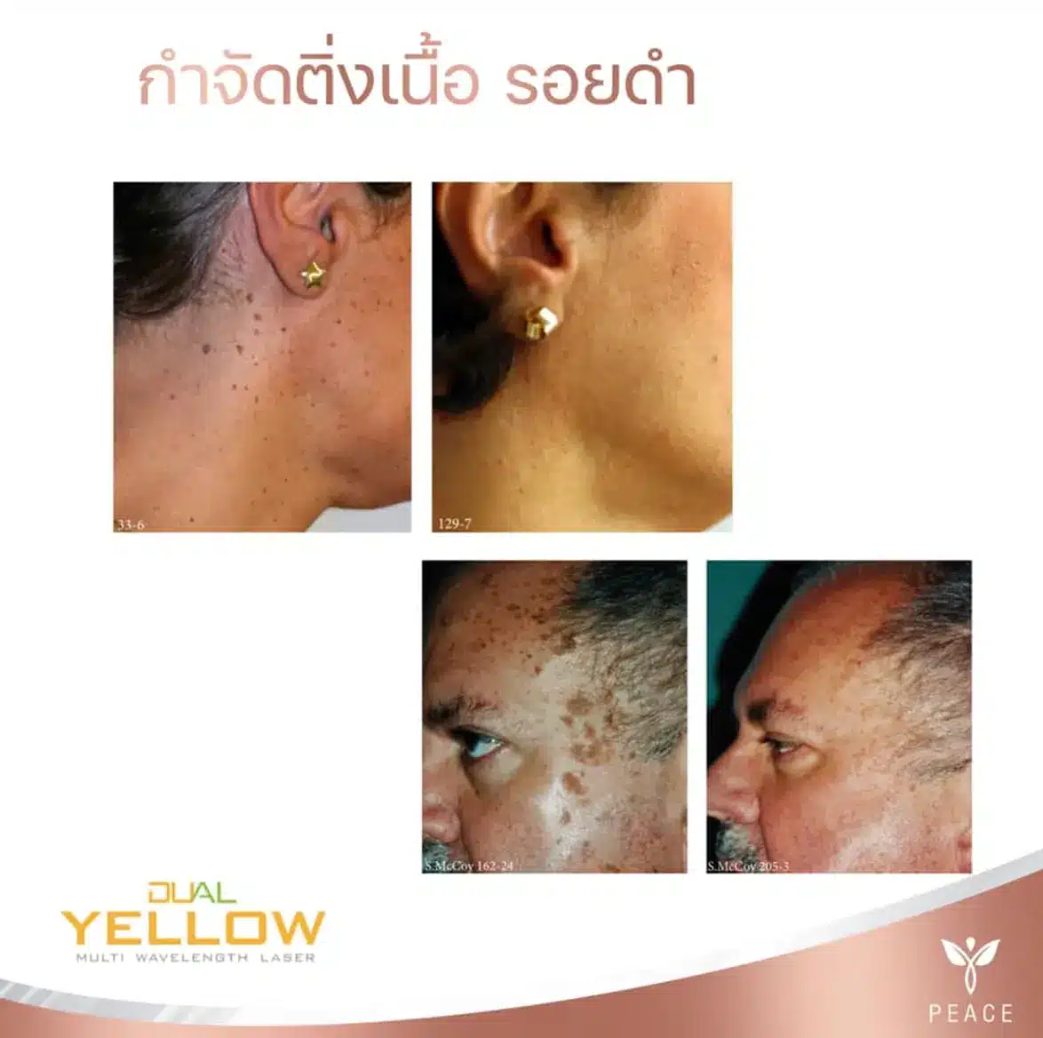 Dual Yellow Laser แม่สอด